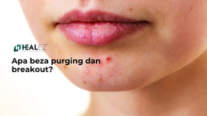 Purging atau Breakout? Ini Cara Nak Bezakan dan Rawat Jerawat