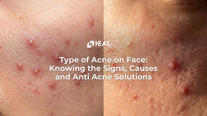 Type of Acne on Face: Knowing the Signs, Causes and Anti Acne Solutions