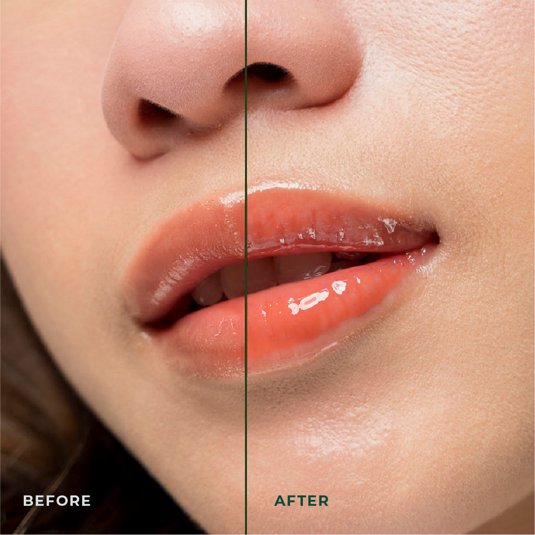 LIPBLOSSOM Treatment